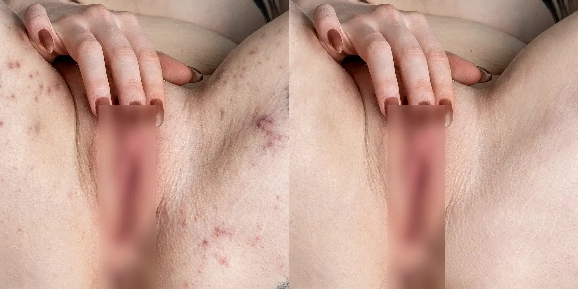Before and after example of Premium Retouching – professional skin correction with blemishes removed while natural skin texture is preserved in a nude photo.